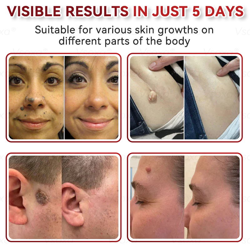CZTICLE® 💧Microneedles Botanical Skin Tags Solution Patches - Made in the USA👩‍⚕️