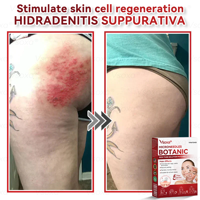 CZTICLE® 💧Microneedles Botanical Skin Tags Solution Patches - Made in the USA👩‍⚕️