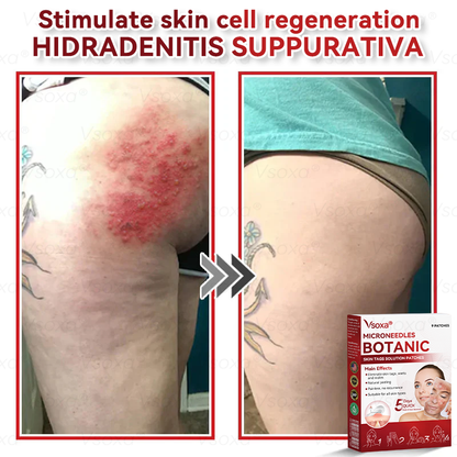 CZTICLE® 💧Microneedles Botanical Skin Tags Solution Patches - Made in the USA👩‍⚕️