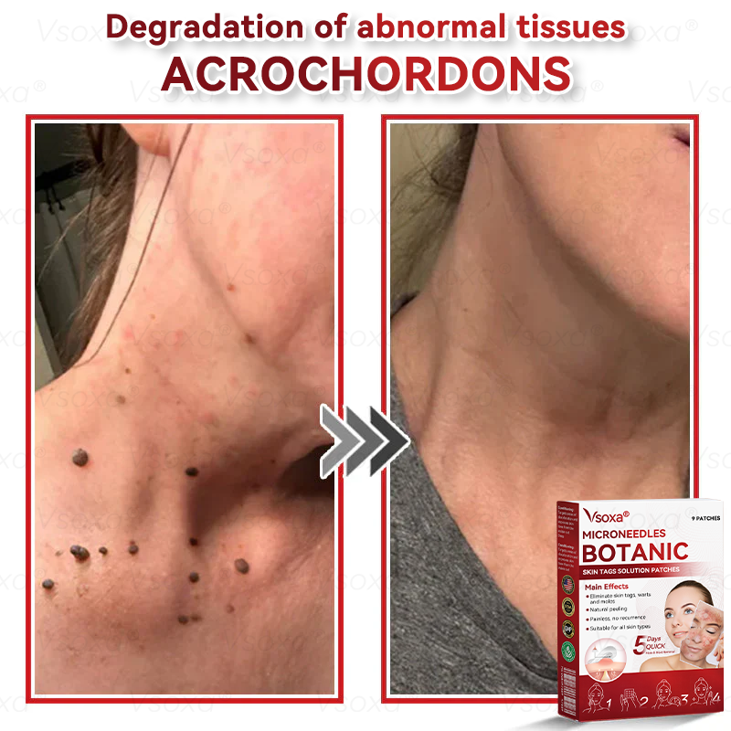 CZTICLE® 💧Microneedles Botanical Skin Tags Solution Patches - Made in the USA👩‍⚕️