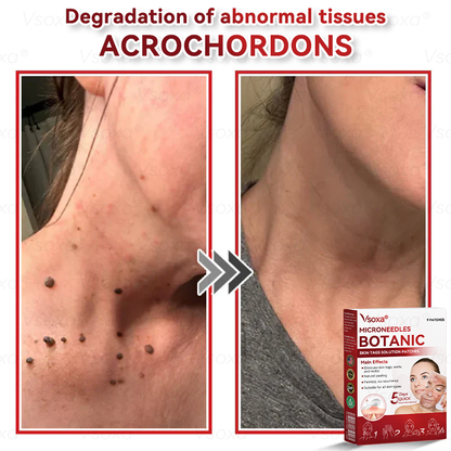 CZTICLE® 💧Microneedles Botanical Skin Tags Solution Patches - Made in the USA👩‍⚕️
