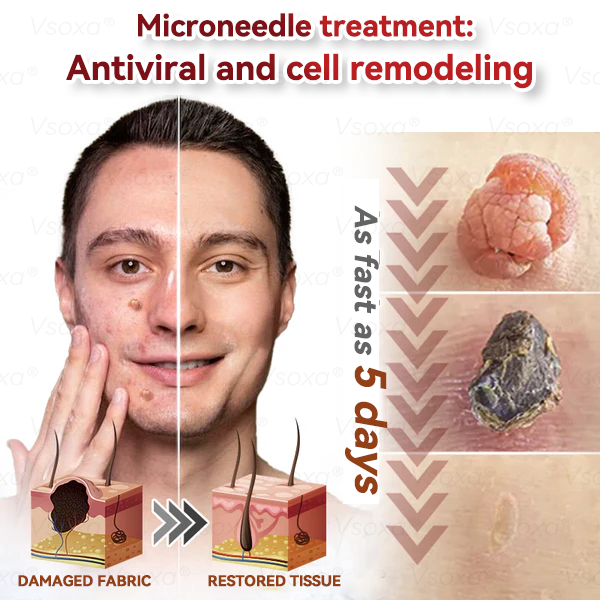CZTICLE® 💧Microneedles Botanical Skin Tags Solution Patches - Made in the USA👩‍⚕️