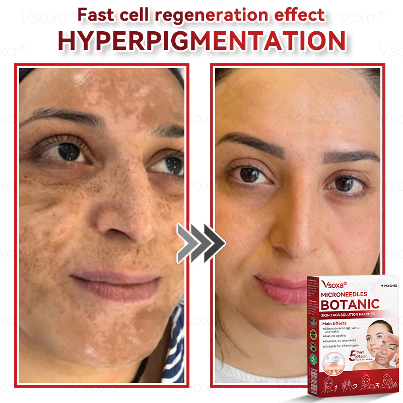 CZTICLE® 💧Microneedles Botanical Skin Tags Solution Patches - Made in the USA👩‍⚕️